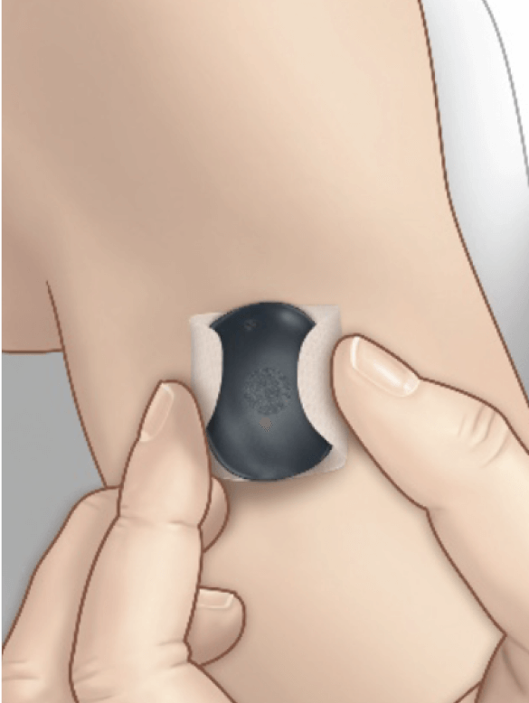 Eine Hand befestigt einen kleinen, schwarzen medizinischen CGM Sensor an einem Oberarm in einer klinischen Umgebung.