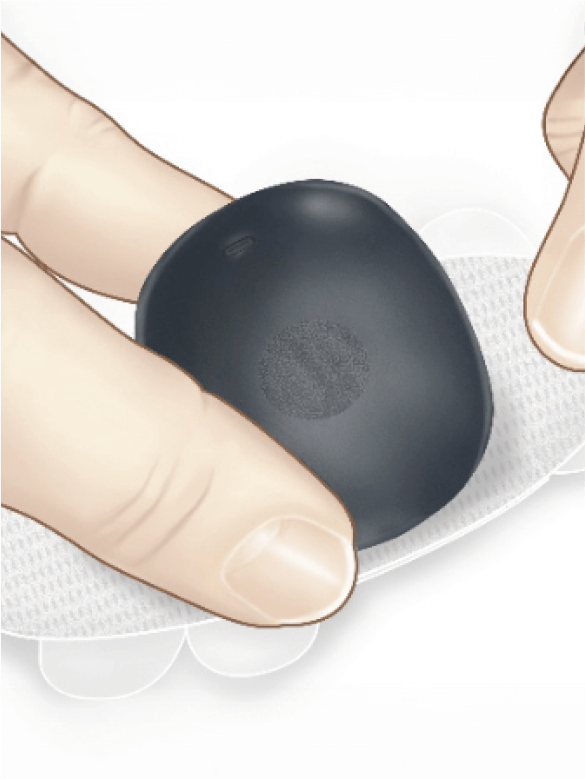 Finger drücken den kleinen Eversense CGM Transmitter an.